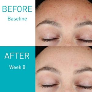 CeraVe Resurfacing Retinol Serum 30ml | Post-Acne Marks, Brightening & Pore Minimizer